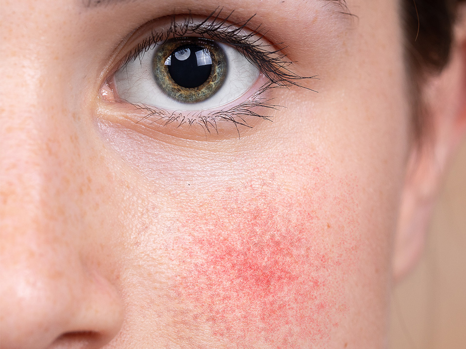 Close-Up einen Gesichtes mit Couperose